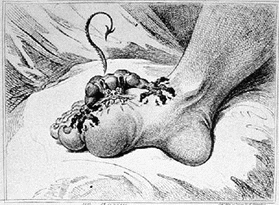 Historic Picture  of what Gout  felt like, courtesy Dr. Burton S. Schuler, podiatrist, foot doctor, Panama City Fl 