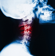 How Chronic Pain Kills: In Interview with Jesse Cannone, Ex-Spine Surgeon Dr. David Hanscom Warns Against Back Surgery