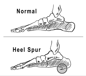 Florida Podiatrist Explains Heel Spurs