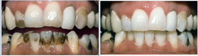 Close-up of a person's mouth and teeth