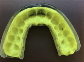 Zone Mouthguard